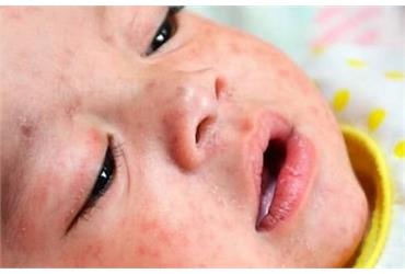 ابتلای ۳ کودک هرمزگانی به سرخک/ واکسیناسیون کودکان را جدی بگیرید